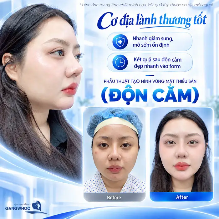 Is Chin Augmentation Permanent? A Detailed Explanation by the Doctor