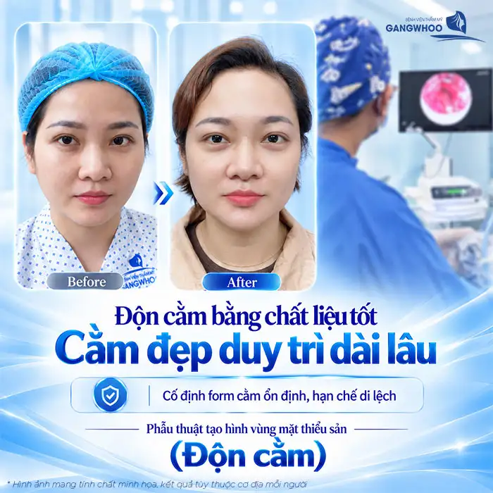 Is Chin Augmentation Permanent? A Detailed Explanation by the Doctor