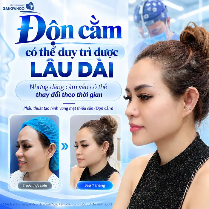 Is Chin Augmentation Permanent? A Detailed Explanation by the Doctor