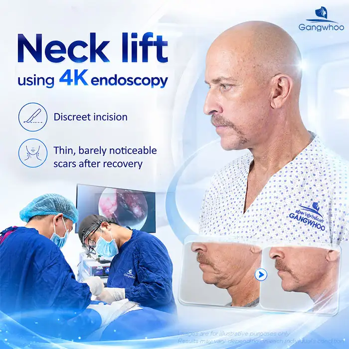 How Much Does a Neck Lift Cost? Latest Neck Lift Price List
