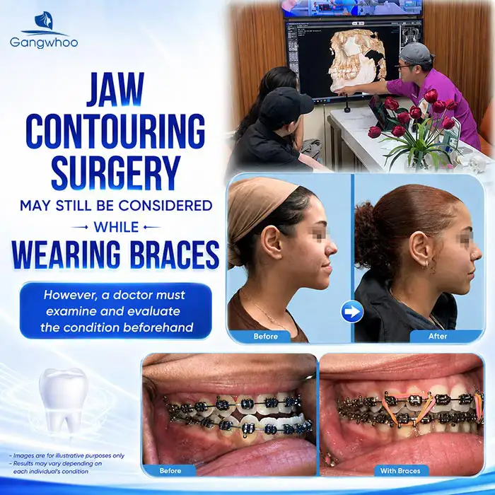 Can You Get Jawline Contouring While Wearing Braces? A Doctor Explains