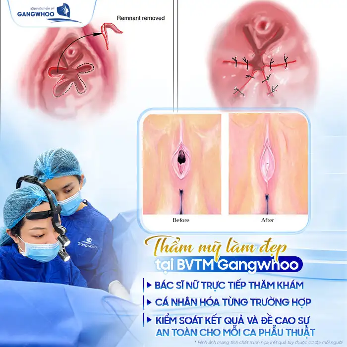Vá Màng Trinh Được Không Khi Đã Quan Hệ Nhiều Lần?