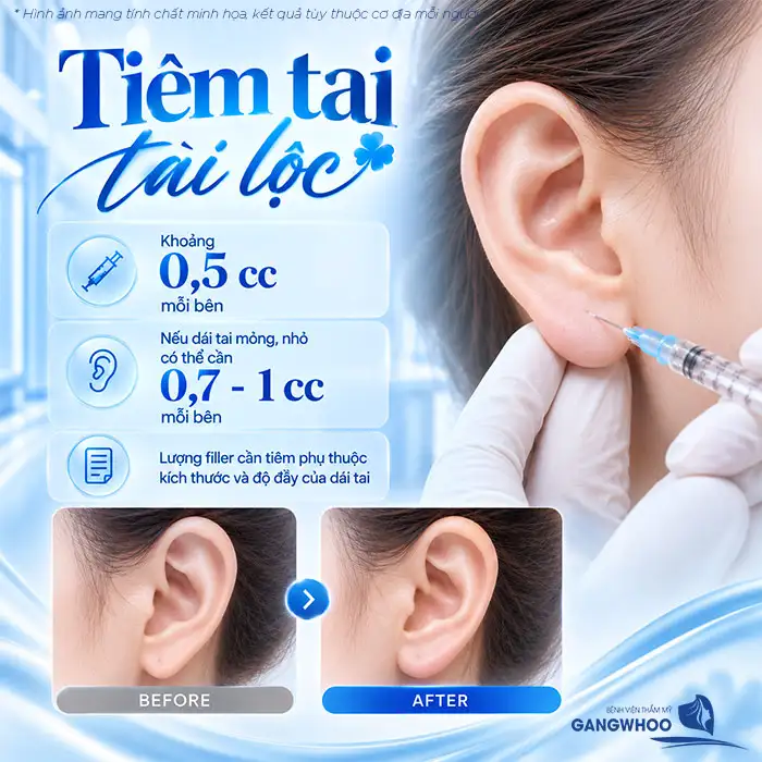 How Many CCs of Filler Are Needed for Fortune Ears? Doctor Advises on the Appropriate Filler Volume