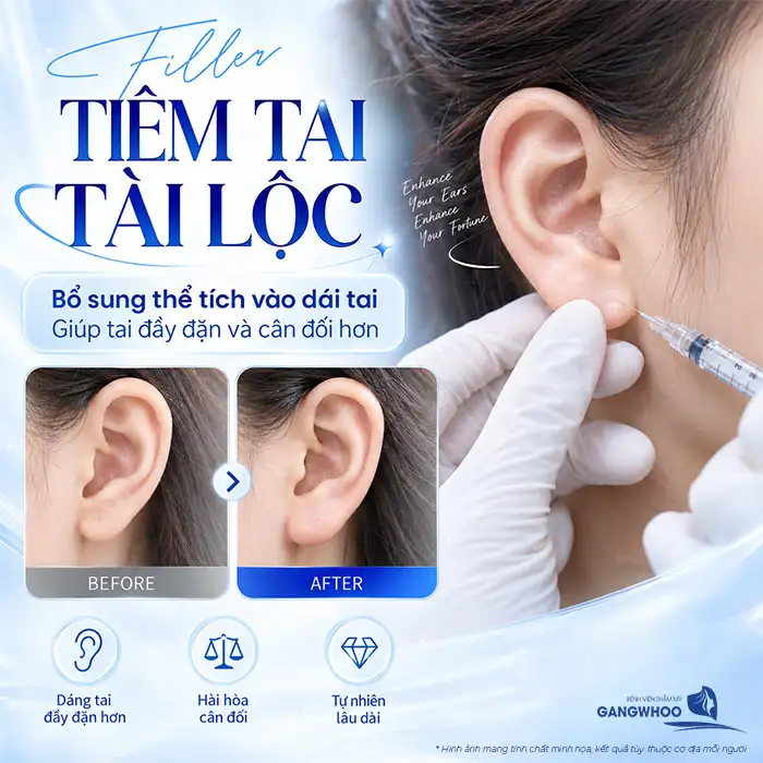 How Many CCs of Filler Are Needed for Fortune Ears? Doctor Advises on the Appropriate Filler Volume