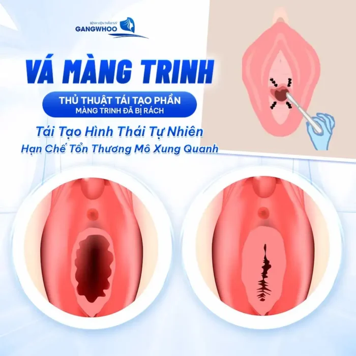 Vá Màng Trinh Có Nguy Hiểm Không? Bác Sĩ Thẩm Mỹ Giải Đáp