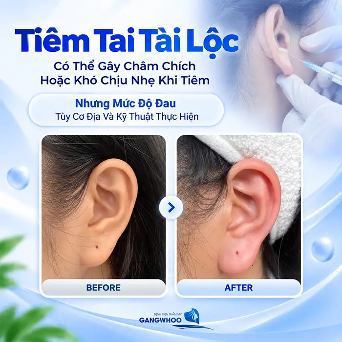 Tiêm Tai Tài Lộc Có Đau Không? Có Cần Gây Tê, Sưng Đau Bao Lâu?