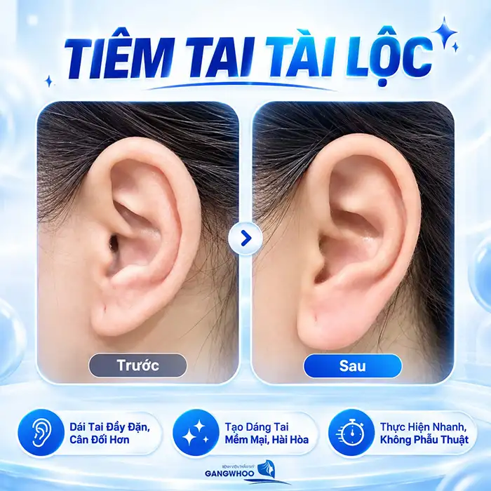 Tiêm Tai Tài Lộc Giá Bao Nhiêu? Có Nên Tiêm Filler Giá Rẻ