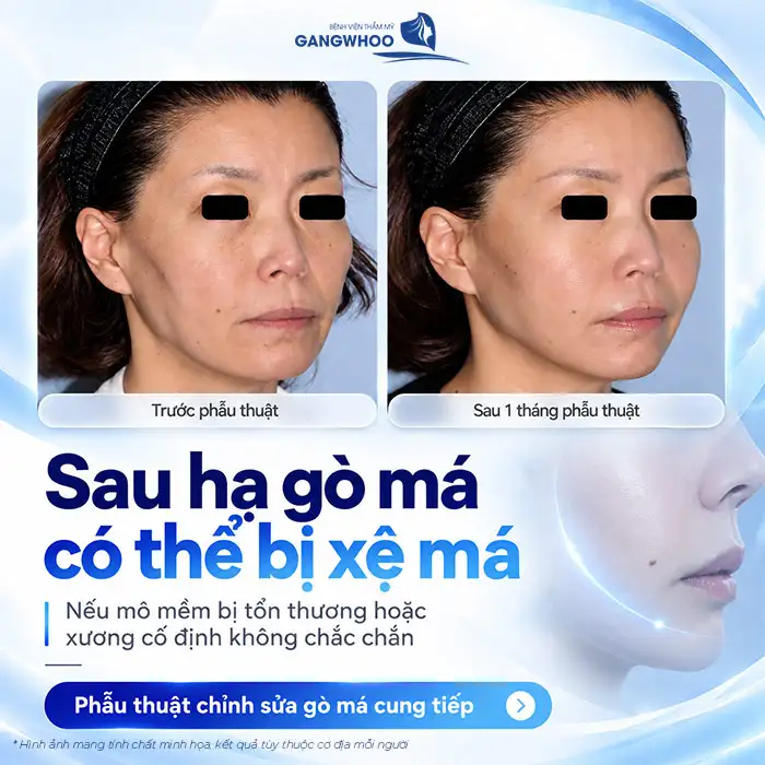 Hạ Gò Má Có Bị Xệ Mặt Không? Nguyên Nhân & Cách Khắc Phục Triệt Để